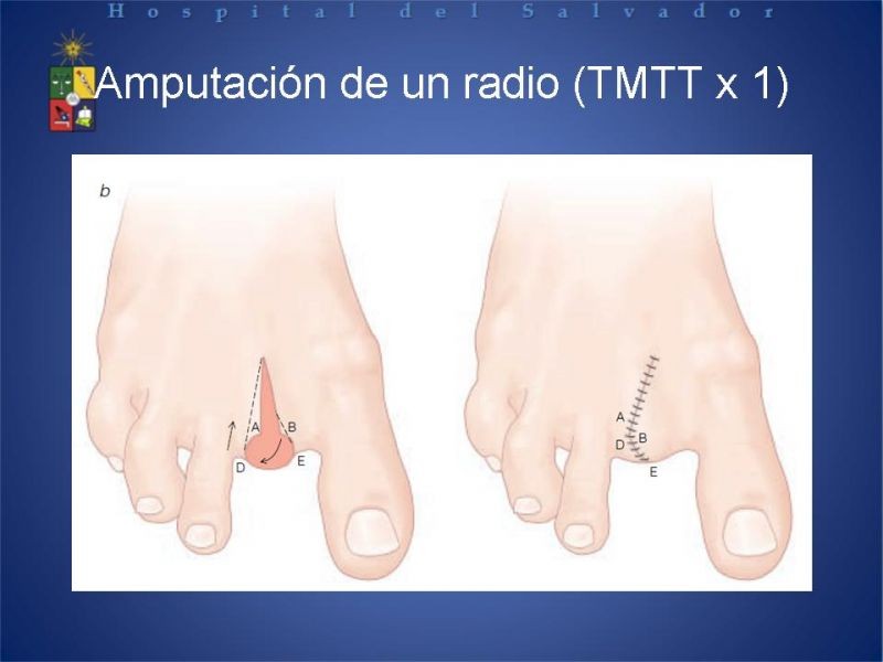 Diapositiva 28 de Amputaciones de extremidades inferiores
