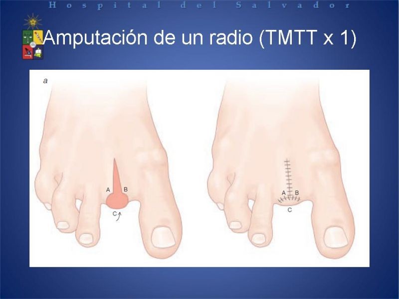 Diapositiva 27 de Amputaciones de extremidades inferiores