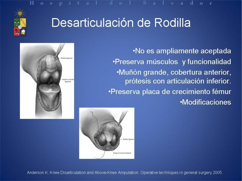 Diapositiva 43 de Amputaciones de extremidades inferiores