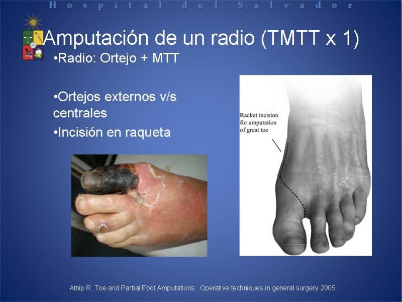 Diapositiva 23 de Amputaciones de extremidades inferiores