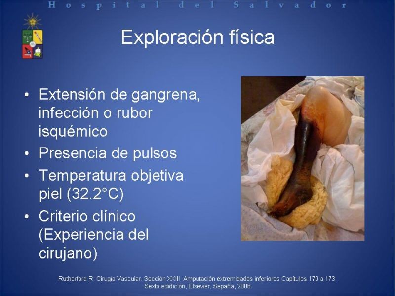 Diapositiva 10 de Amputaciones de extremidades inferiores