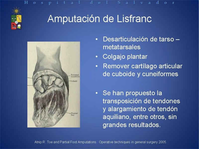 Diapositiva 33 de Amputaciones de extremidades inferiores
