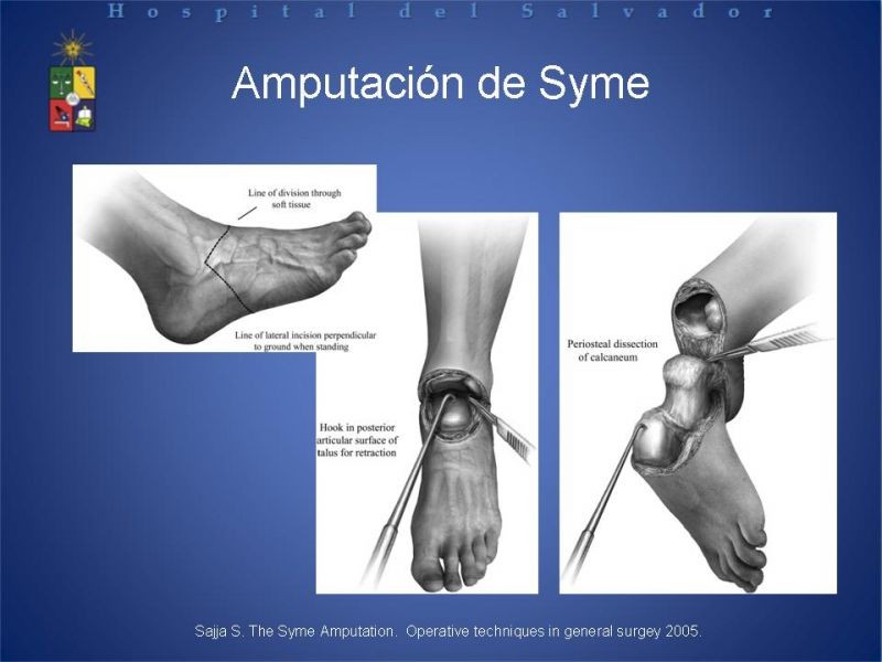 Diapositiva 36 de Amputaciones de extremidades inferiores