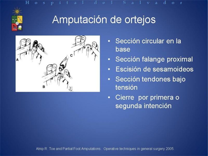 Diapositiva 19 de Amputaciones de extremidades inferiores