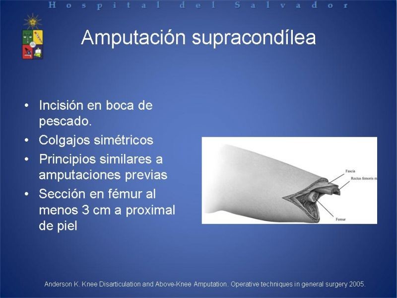 Diapositiva 45 de Amputaciones de extremidades inferiores