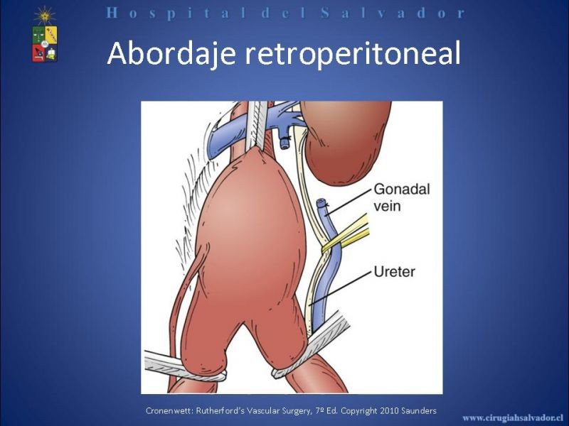 Diapositiva 22 de Abordaje de Aorta abdominal