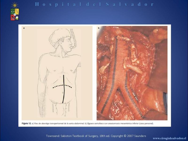 Diapositiva 12 de Abordaje de Aorta abdominal