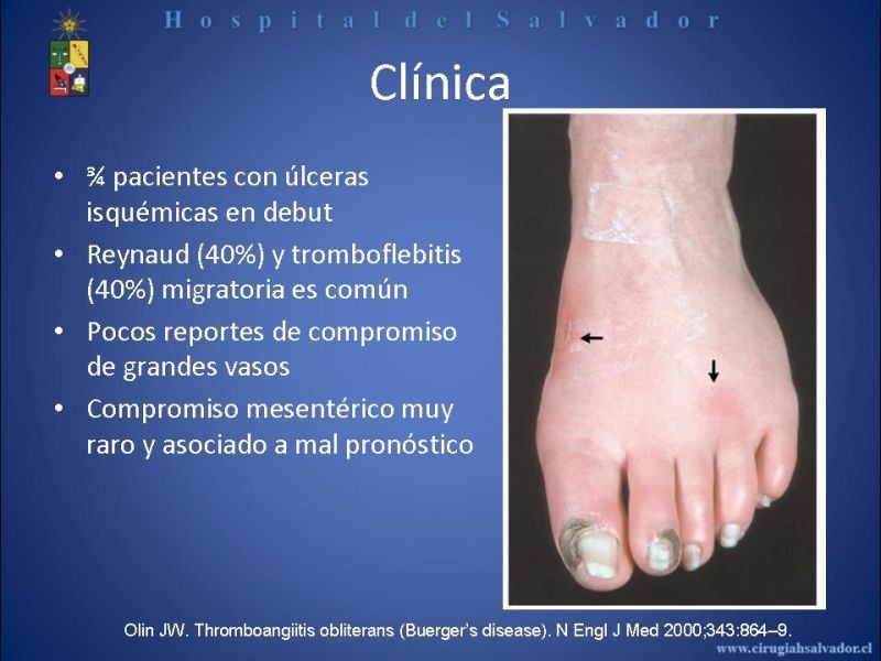 Diapositiva 13 de Tromboangeitis Obliterante(Enfermedad de Buerger)