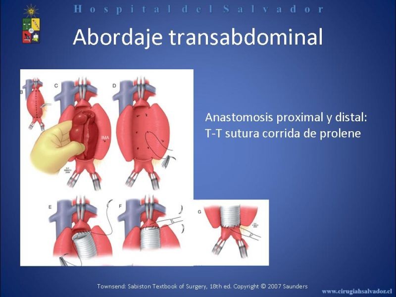 Diapositiva 16 de Abordaje de Aorta abdominal