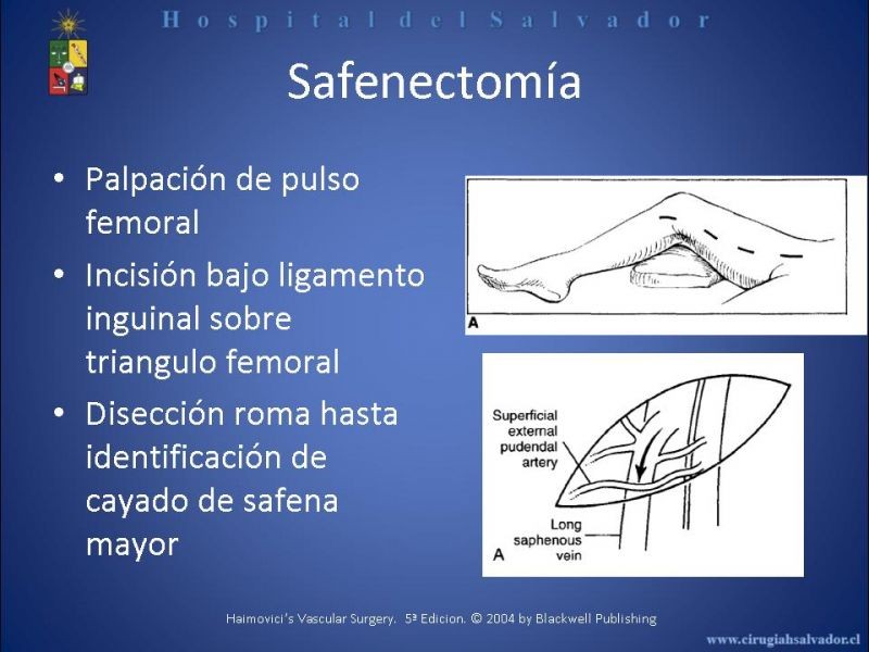 Diapositiva 8 de Safenectomía