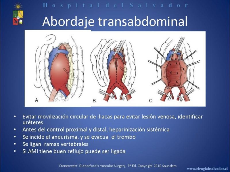 Diapositiva 15 de Abordaje de Aorta abdominal