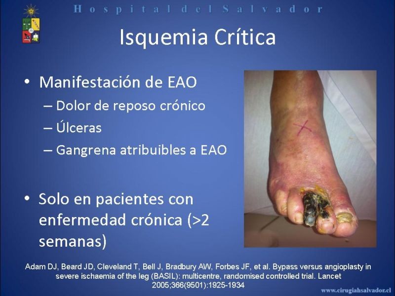 Diapositiva 1 de Angioplastía vs By Pass en isquémia crítica