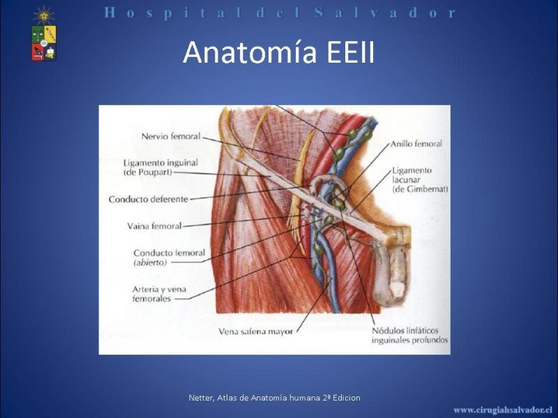 Diapositiva 4 de Safenectomía