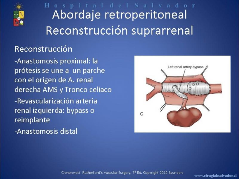 Diapositiva 25 de Abordaje de Aorta abdominal