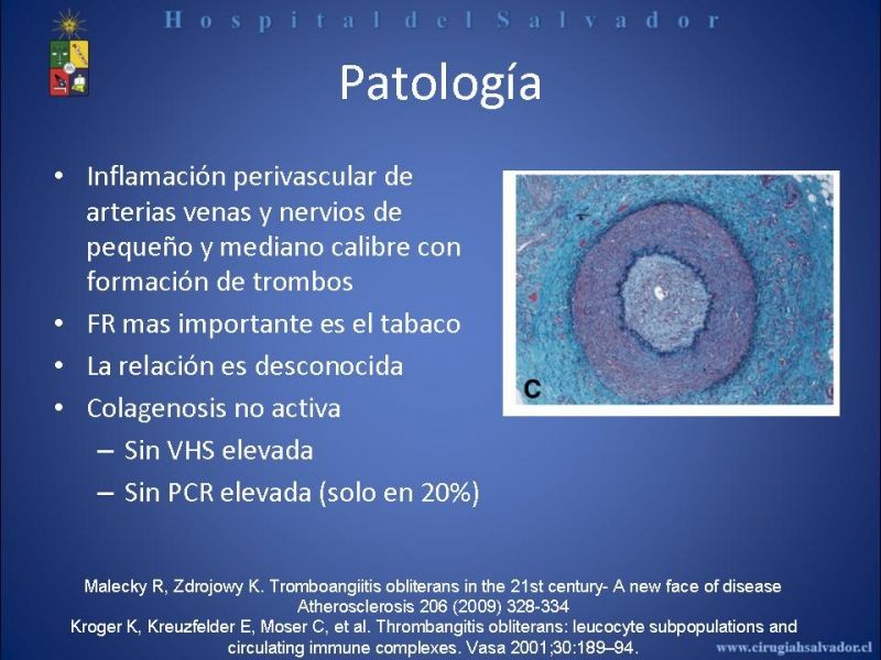 Diapositiva 9 de Tromboangeitis Obliterante(Enfermedad de Buerger)