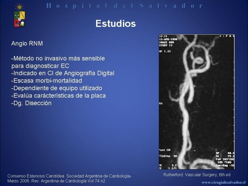 Diapositiva 7 de Patología Carotídea