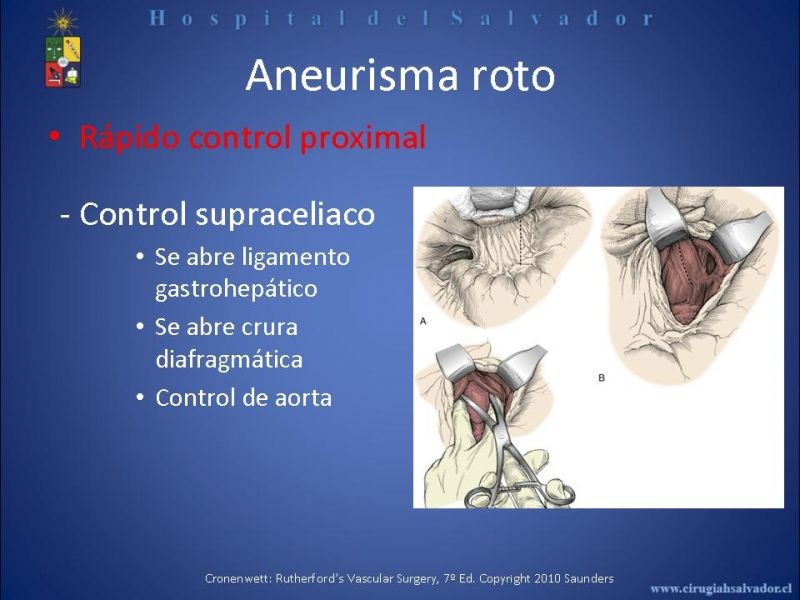 Diapositiva 26 de Abordaje de Aorta abdominal