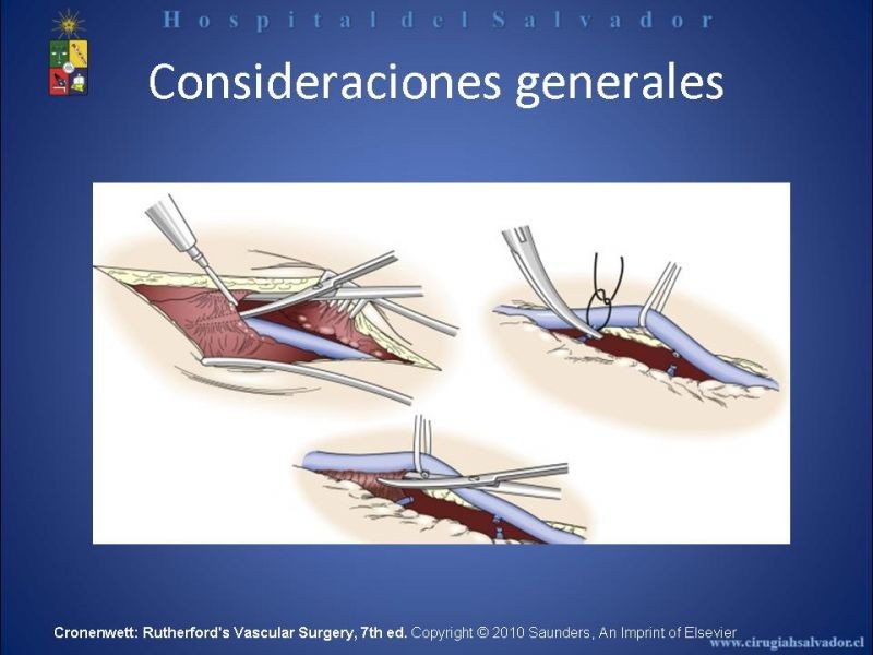 Diapositiva 7 de Safenectomía