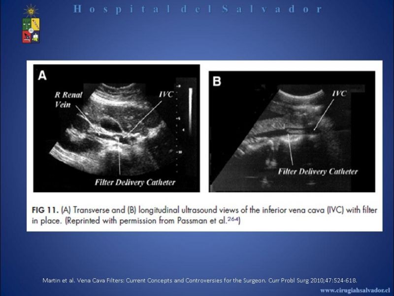 Diapositiva 18 de Filtro Vena Cava