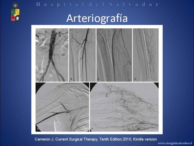 Diapositiva 18 de Tromboangeitis Obliterante(Enfermedad de Buerger)