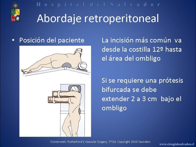 Diapositiva 20 de Abordaje de Aorta abdominal