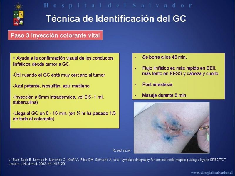 Diapositiva 30 de Rol del Ganglio Centinela en Melanoma