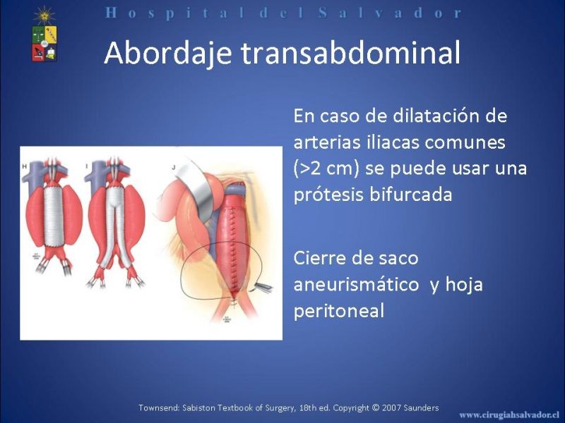 Diapositiva 17 de Abordaje de Aorta abdominal