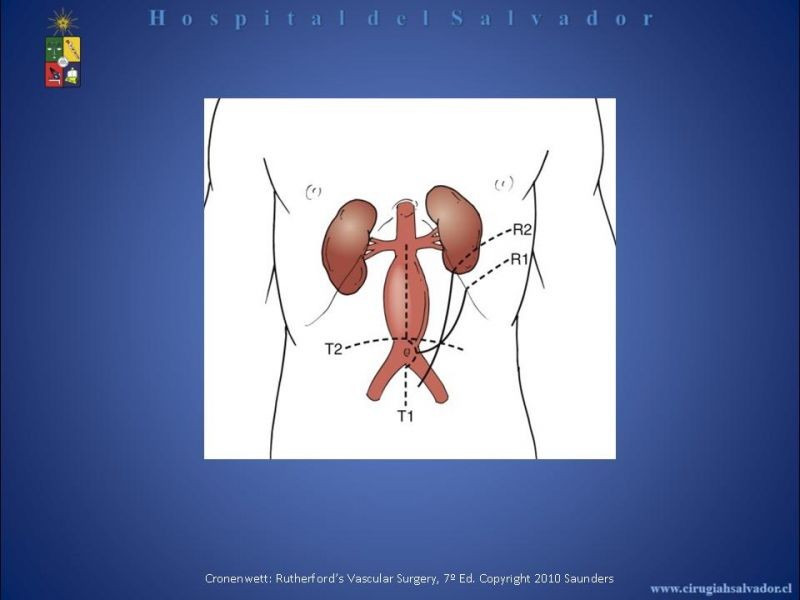 Diapositiva 10 de Abordaje de Aorta abdominal