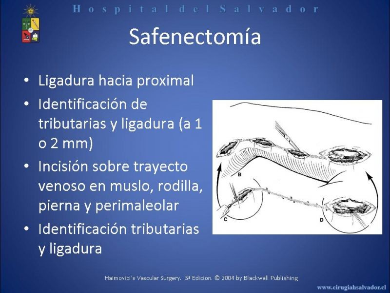 Diapositiva 9 de Safenectomía