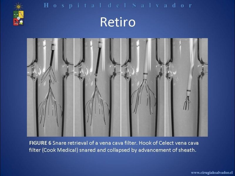 Diapositiva 21 de Filtro Vena Cava