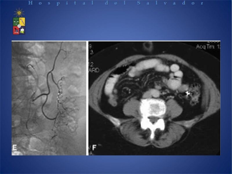 Diapositiva 14 de Cirugía endovascular en HDB