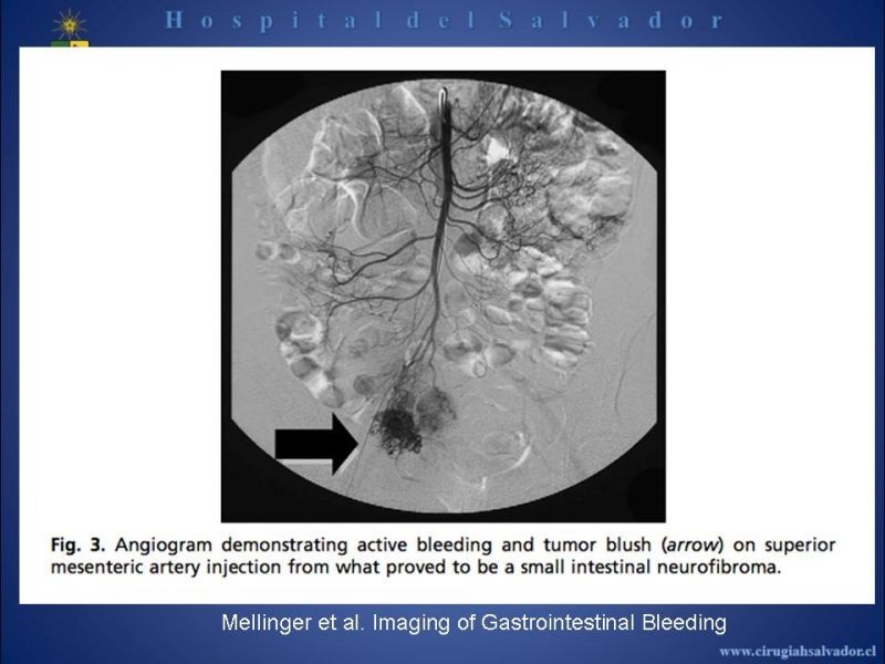 Diapositiva 7 de Angiografía en Hemorragia Digestiva