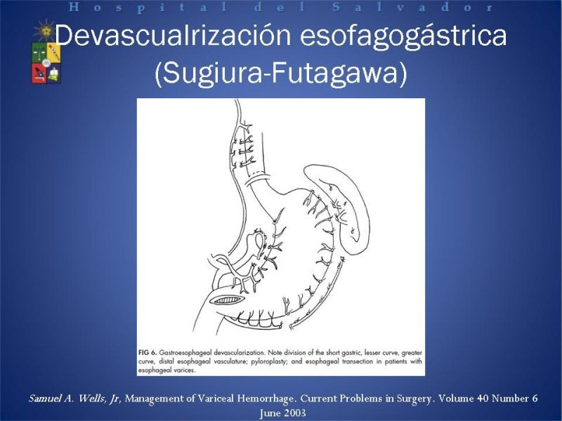 Diapositiva 21 de Hipertensión Portal:Alternativas Terapeuticas
