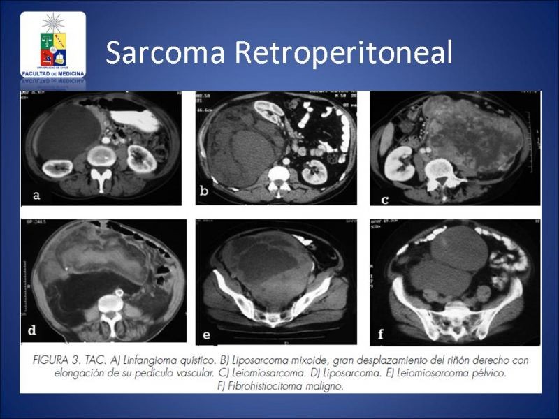 Diapositiva 11 de Sarcoma Retroperitoneal