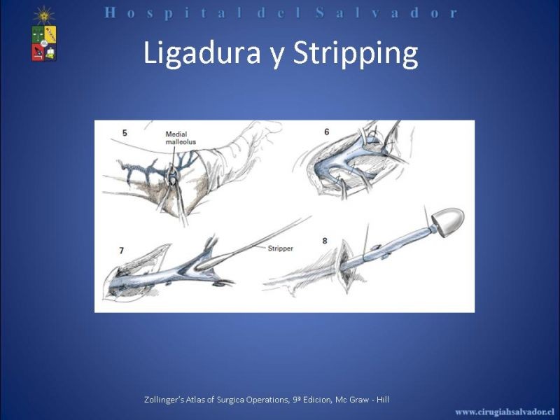 Diapositiva 14 de Safenectomía