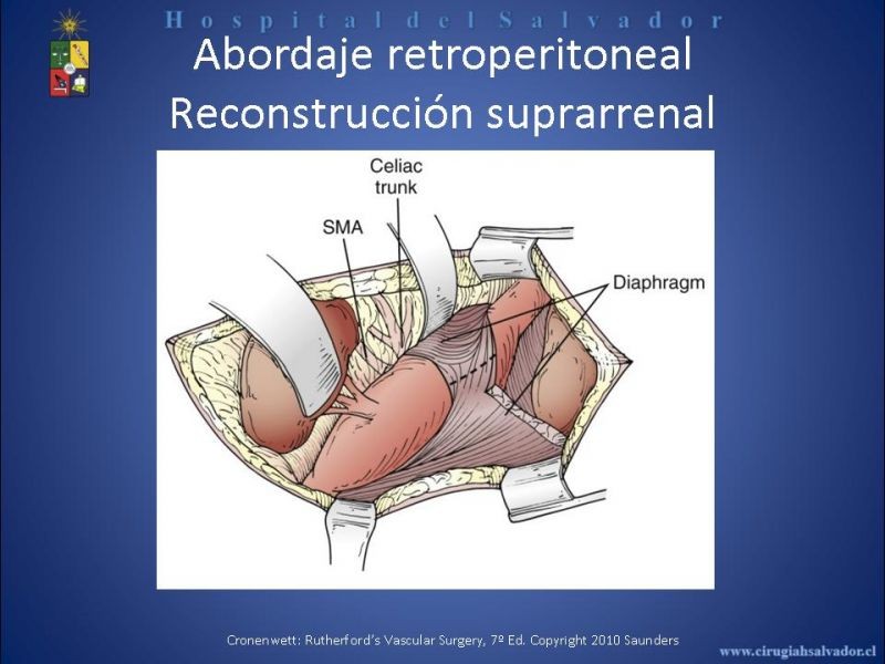 Diapositiva 24 de Abordaje de Aorta abdominal