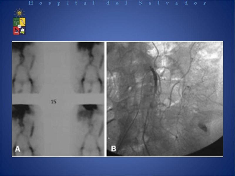Diapositiva 12 de Cirugía endovascular en HDB