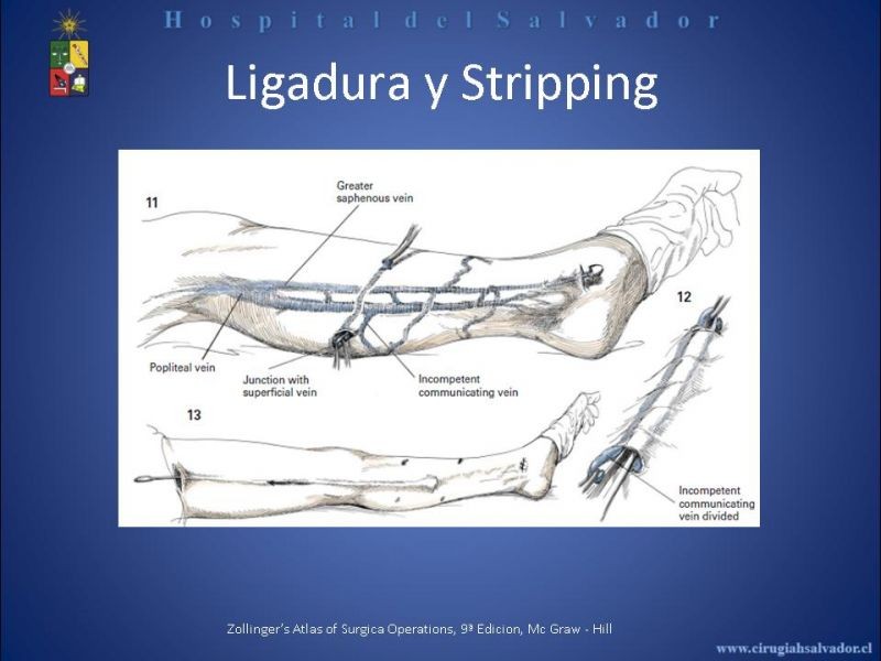 Diapositiva 15 de Safenectomía
