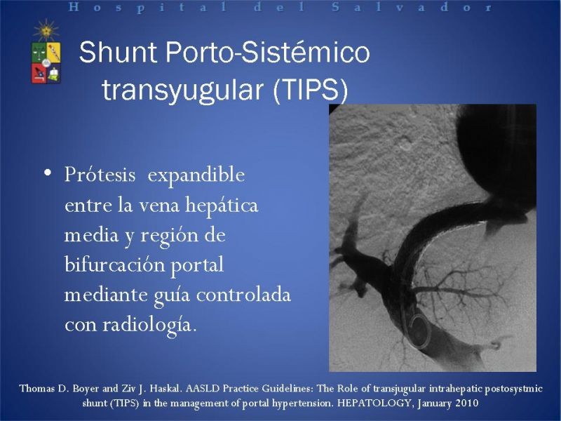 Diapositiva 28 de Hipertensión Portal:Alternativas Terapeuticas