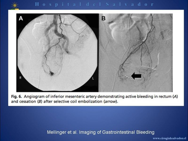 Diapositiva 16 de Angiografía en Hemorragia Digestiva