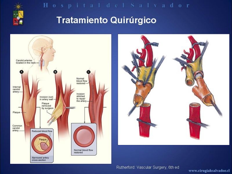 Diapositiva 18 de Patología Carotídea