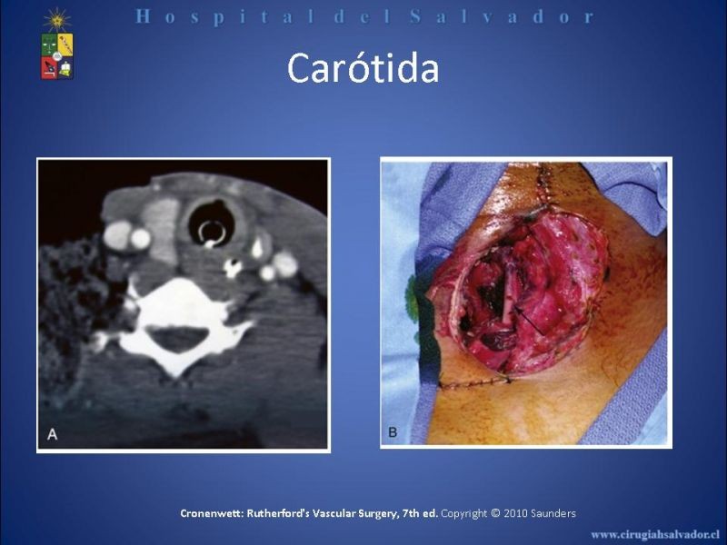 Diapositiva 22 de Trauma Vascular Cervical