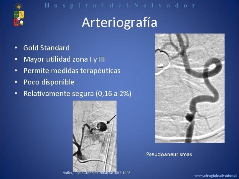Diapositiva 18 de Trauma Vascular Cervical
