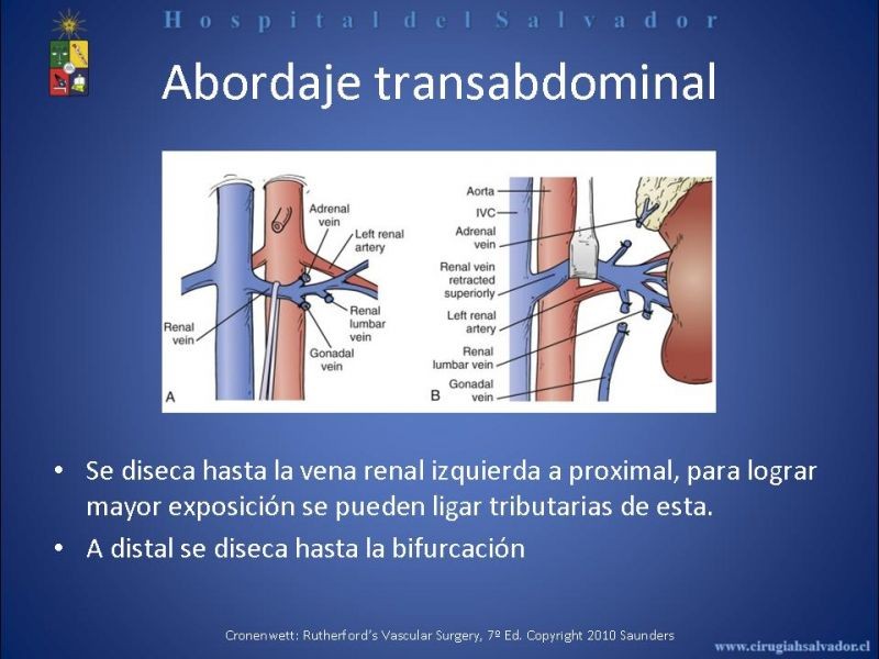 Diapositiva 14 de Abordaje de Aorta abdominal
