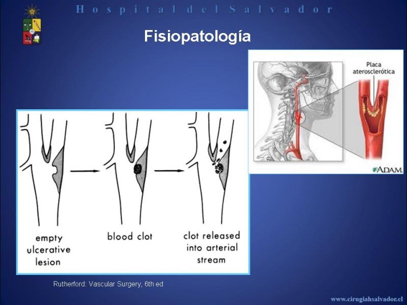 Diapositiva 3 de Patología Carotídea