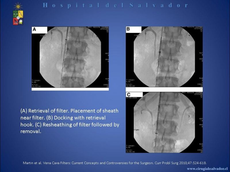 Diapositiva 22 de Filtro Vena Cava