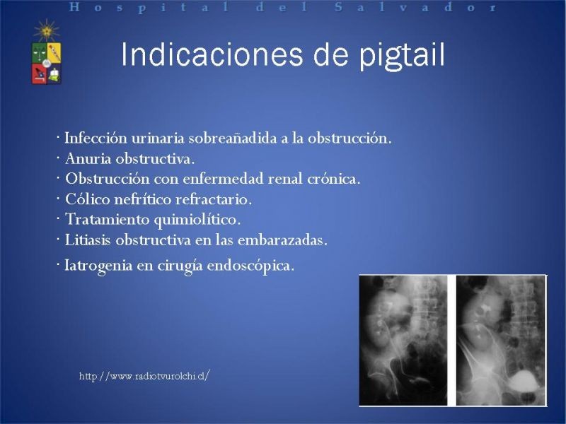 Diapositiva 17 de Urolitiasis