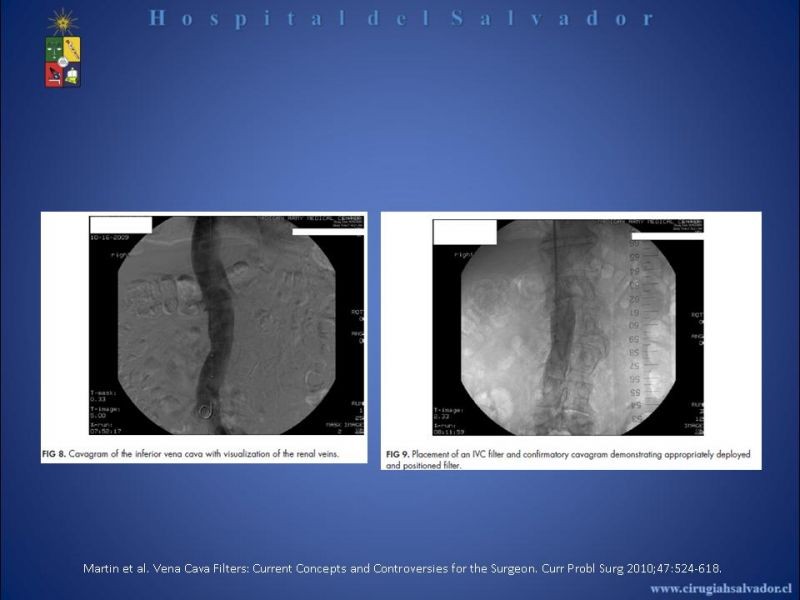 Diapositiva 17 de Filtro Vena Cava