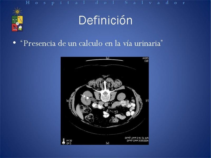 Diapositiva 1 de Urolitiasis