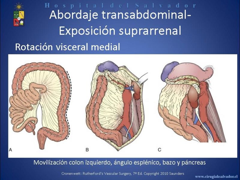 Diapositiva 19 de Abordaje de Aorta abdominal